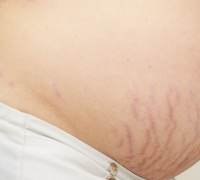Postpartum Abdominal and Hip Fissure Treatment